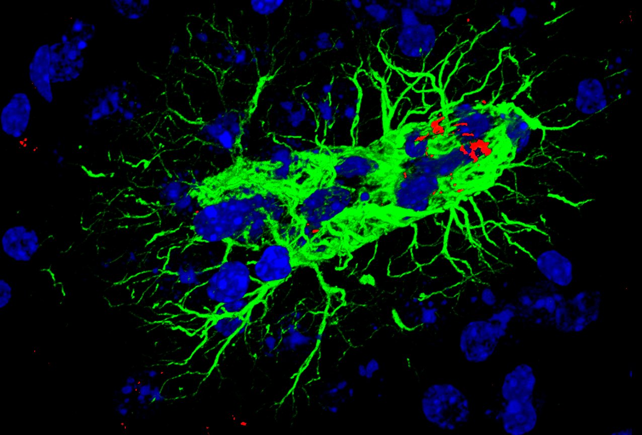 Nebulosa astrocitaria